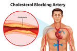 Der Cholesterinspiegel in der Ernährung